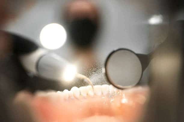 Close-up of ultrasonic scaler cleaning upper teeth, water mist and dental mirror visible.