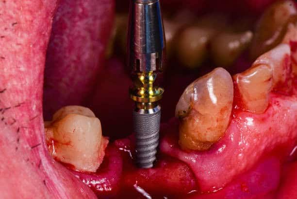 Titanium dental implant being inserted in lower jaw during surgical placement procedure.