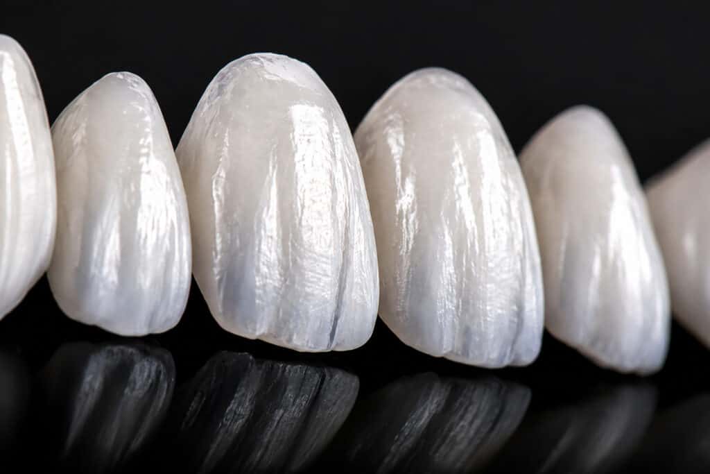 Macro close-up of translucent porcelain dental veneers showing lifelike enamel texture