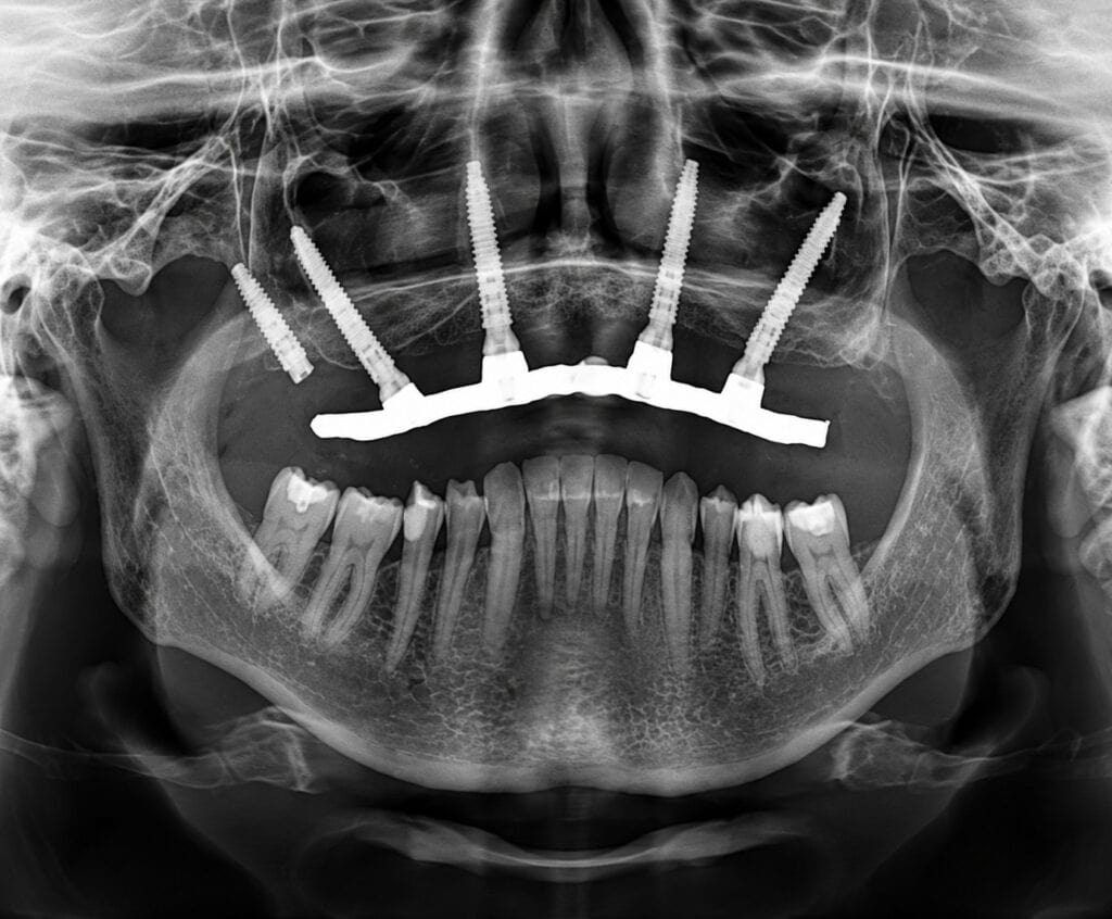 Radiografia panoramica dentale che mostra impianti mascellari multipli a supporto di un ponte fisso completo.