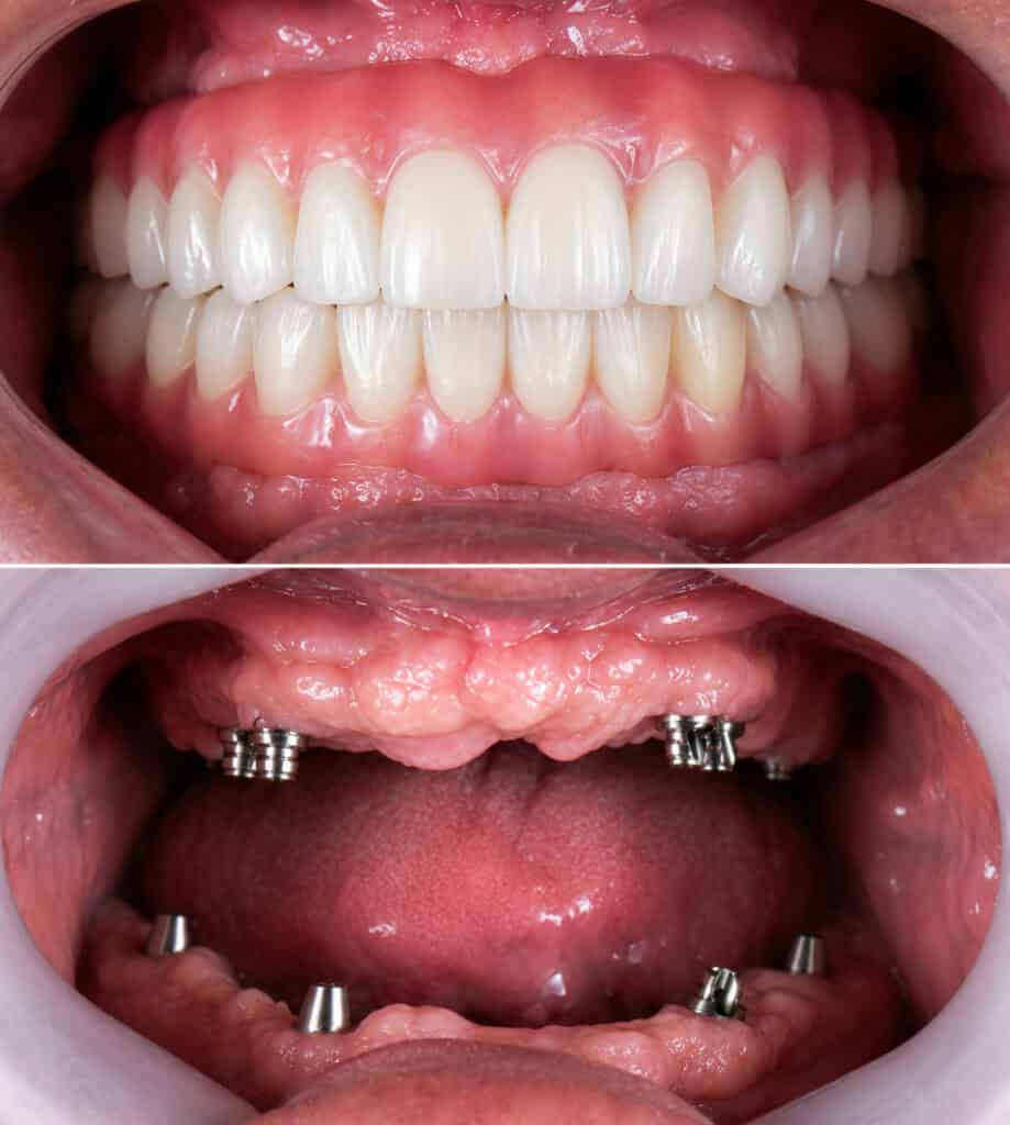 - Composite: Before-and-after showing upper jaw implant abutments and final full-arch fixed teeth.- Top panel: Close-up of natural-looking full-arch fixed teeth after implant restoration.- Bottom panel: Upper jaw with multiple dental implant abutments prepared for bridge placement.