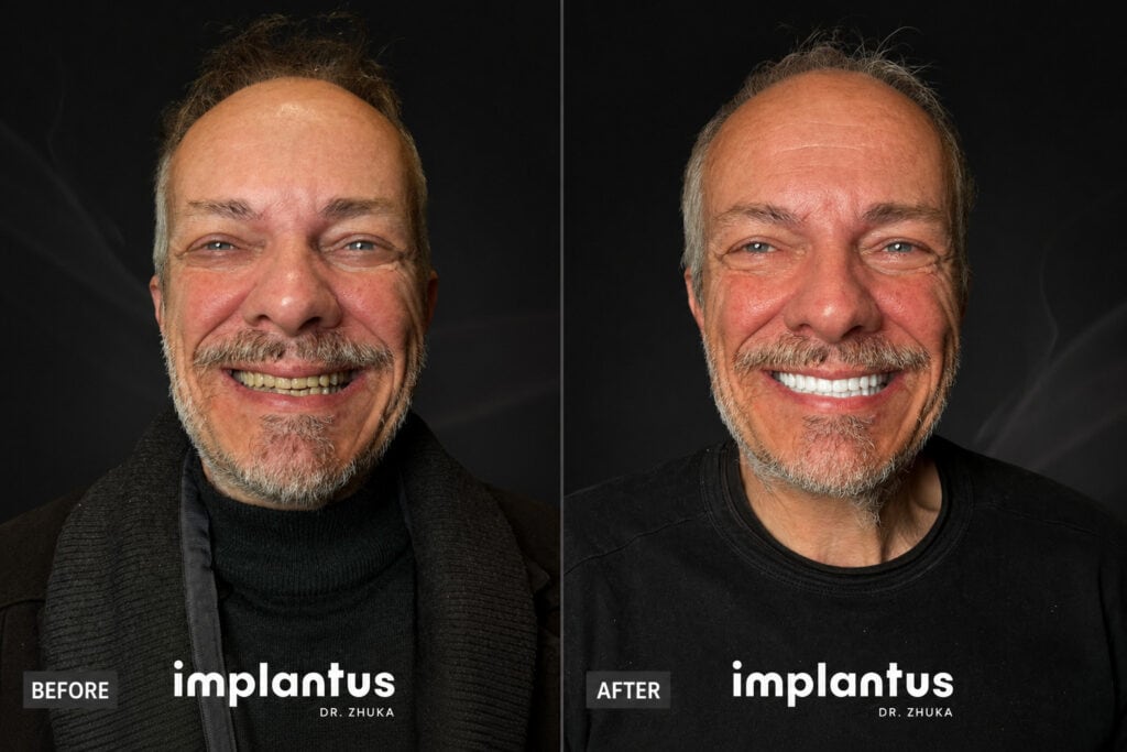 Side-by-side before-and-after of smiling patient at Implantus Dental Clinic Tirana, worn teeth to bright smile.