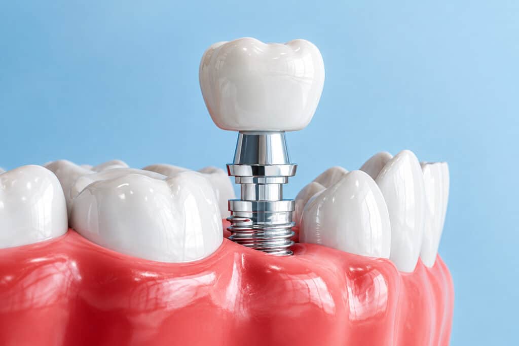 Dentisti me doreza blu tregon radiografinë panoramike ku shfaqen implantet dentare.