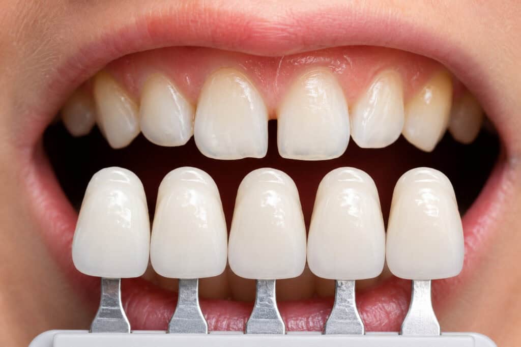 Dentisti i shpjegon pacientit radiografinë panoramike gjatë konsultës për implant dentar.
