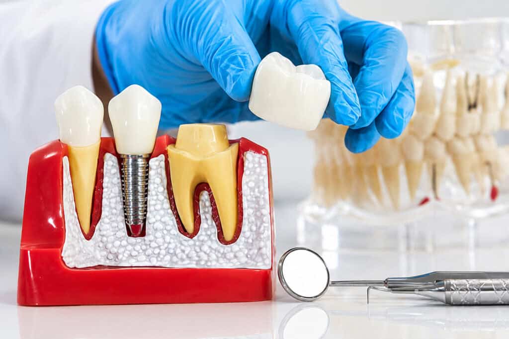 Dentisti paraqet opsionet e implanteve dentare me një model nofulle dhe imazhe të protezave në monitor.