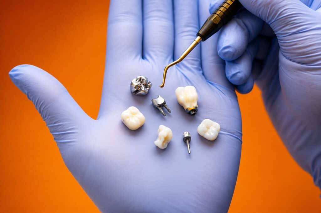 Dentisti shpjegon implantet dentare full-arch duke përdorur një model dhe skanime 3D, me një valixhe pranë.