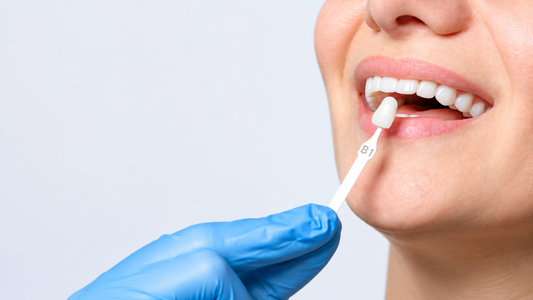 Gloved hand holds B1 shade tab against patient’s teeth for porcelain veneer matching.