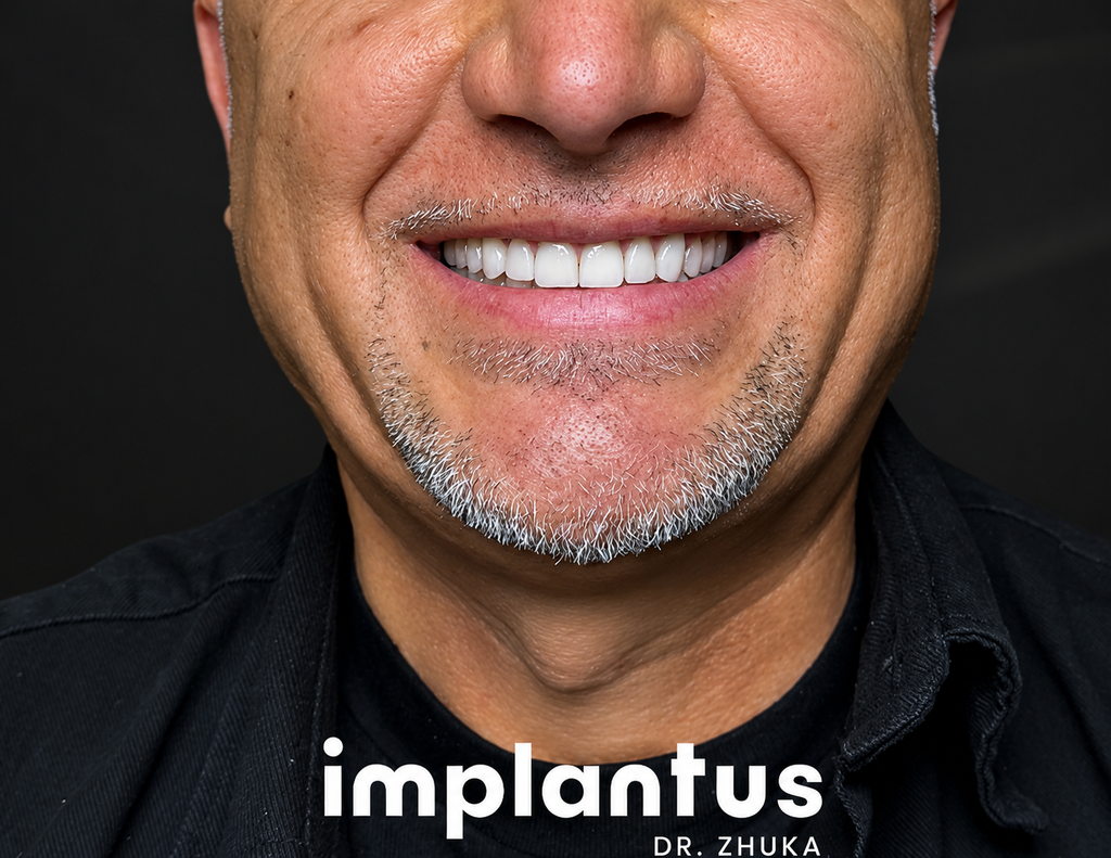 Gloved dentist compares A2 and B1 shade tabs to patient’s front teeth for veneers.