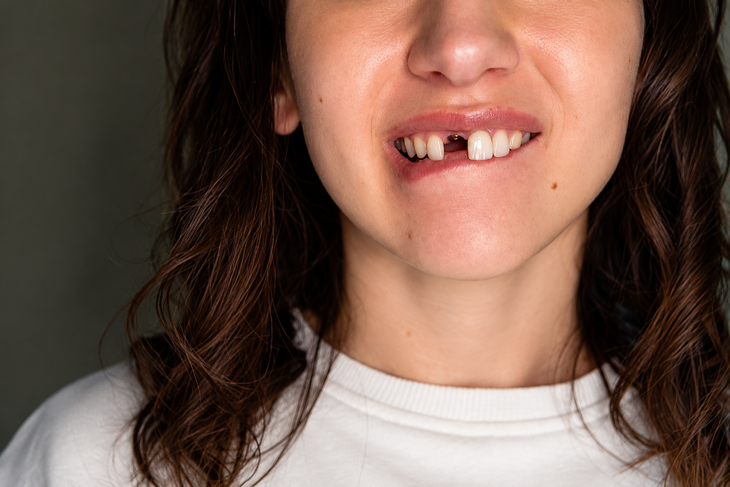 Young woman with missing front teeth, dental health issue.