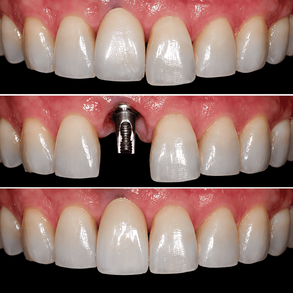 Gros plan sur la pose d’un implant dentaire et la restauration des dents par le Dr Zhuka.